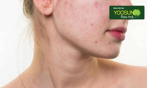 dị ứng nước tẩy trang byphasse