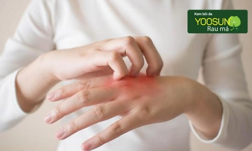 Bệnh sản ngứa sau sinh