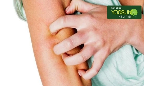 Bị ngứa sau sinh bao lâu thì hết