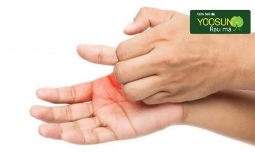 Bị ngứa sau sinh mổ