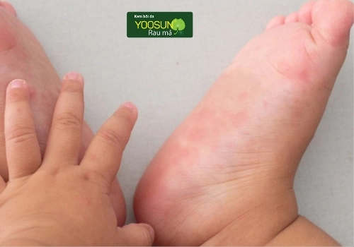 Nguyên nhân bị tay chân miệng ở trẻ em 
