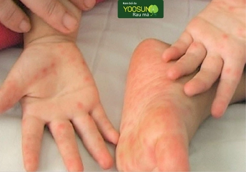 Nguyên nhân trẻ bị tay chân miệng