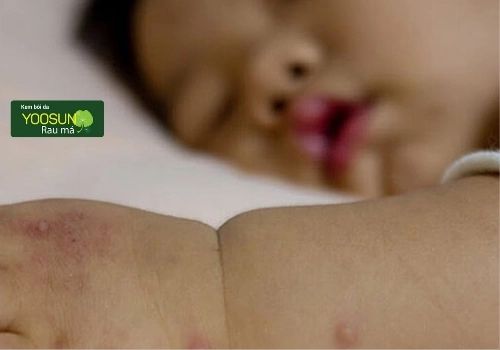 Trẻ bị chân tay miệng có bị lại không