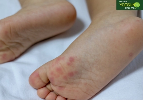 Trẻ bị chân tay miệng có sốt không
