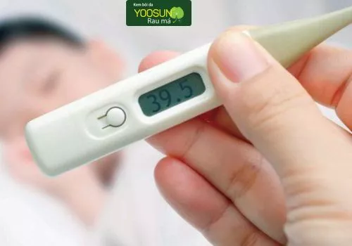 Triệu chứng chân tay miệng ở trẻ em