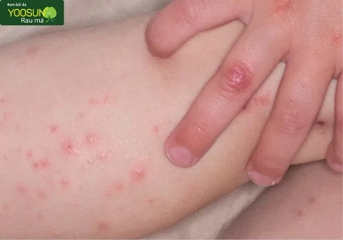 Triệu chứng tay chân miệng ở trẻ em