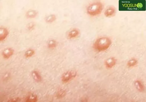 Mụn nước thủy đậu bao lâu thì xẹp