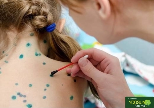 bị thuỷ đậu có được gội đầu không