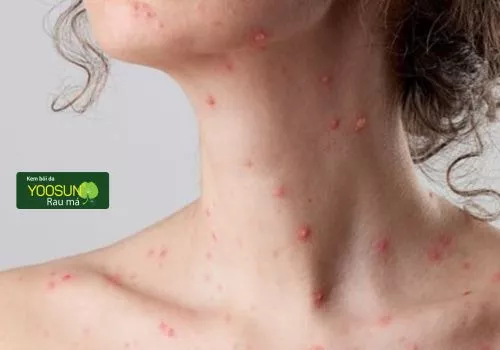 Bị thủy đậu có quan hệ được không