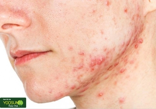 Bị thủy đậu quan hệ có sao không