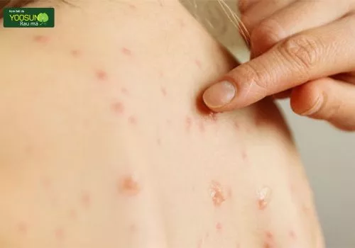 Bị thủy đậu có được ăn xoài không