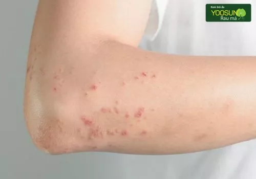 Bị thủy đậu uống nước cam được không