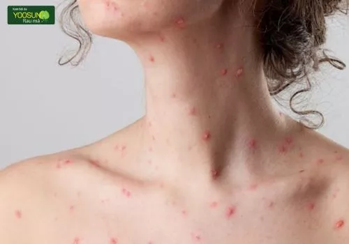 Người bị thủy đậu uống nước mía được không Bị thủy đậu uống nước mía được không