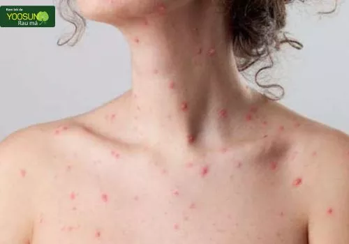 Bị thủy đậu uống nước yến được không
