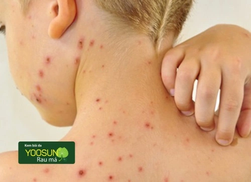 bị thuỷ đậu ăn hải sản được không