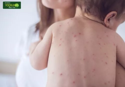 bị thủy đậu ăn vịt được không