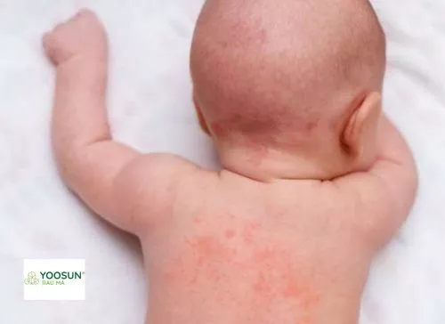 bé bị rôm sảy có mủ do đâu? bé bị rôm sảy có mủ
