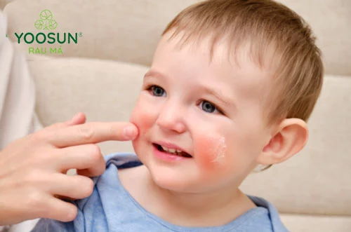 Bệnh chàm sữa cách điều trị