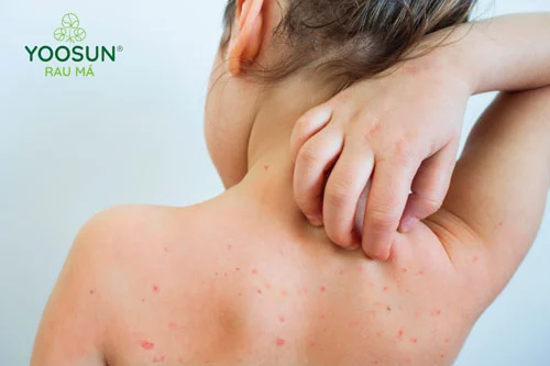 Biểu hiện trẻ bị rôm sảy mùa hè 