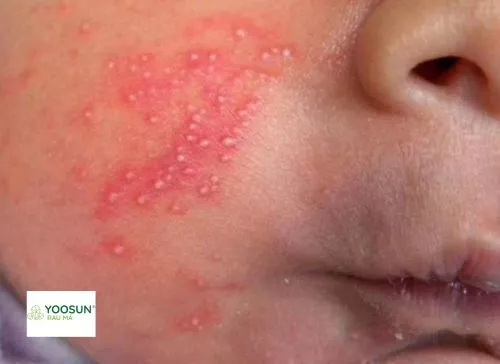 Bị nổi sảy có mủ có nguy hiểm không nổi sảy có mủ có nguy hiểm không