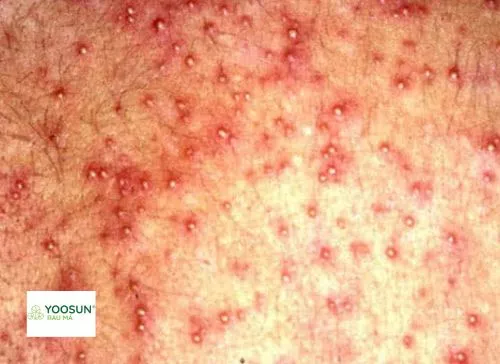 Nổi sảy mủ là như thế nào nổi sảy mủ