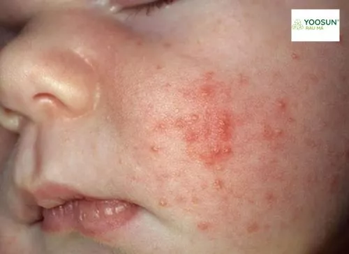 Nguyên nhân bị rôm sảy có mủ là gì Nguyên nhân bị rôm sảy có mủ