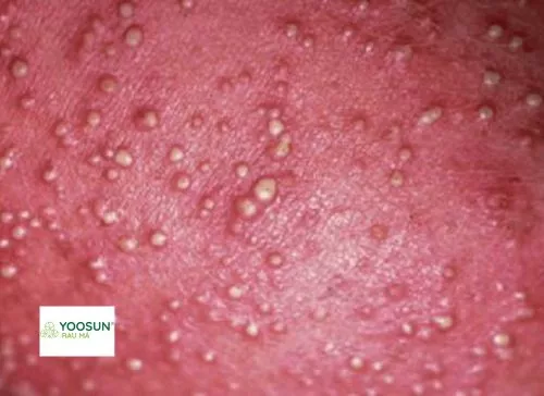 Hình ảnh rôm sảy mủ Rôm sảy mủ