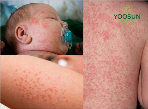 Bị nổi sảy có để lại sẹo không