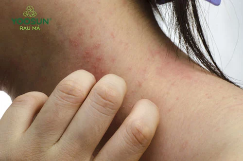 Rôm sảy có để lại sẹo không