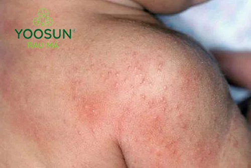Rôm sảy để lại sẹo không