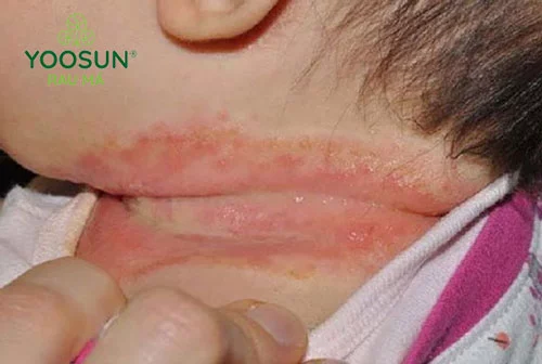 Hăm sữa ở trẻ là gì? Nguyên nhân, giải pháp, phòng ngừa