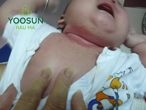 Hăm sữa ở trẻ sơ sinh