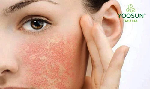 Nên làm gì khi da mặt bị cháy nắng