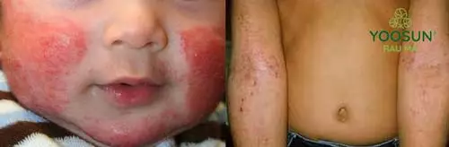 viêm da cơ địa có khỏi không