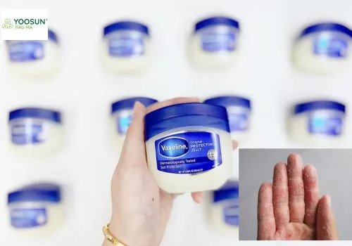 Viêm da cơ địa bôi Vaseline được không? Giải đáp từ dược sĩ